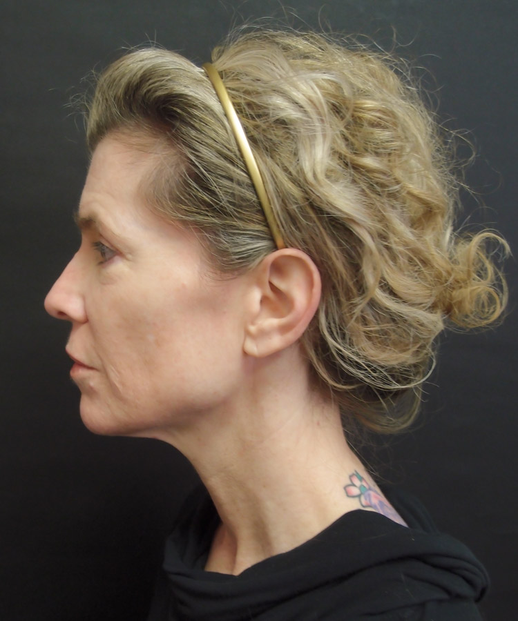 Woman before facelift plastic surgery