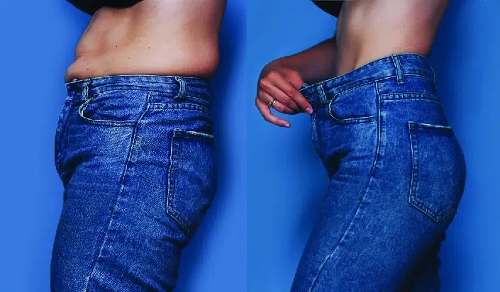 Tummy Tuck Temecula