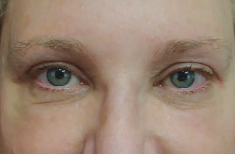 After bilateral upper eyelid blepharoplasty at Advanced Institute for Plastic Surgery, showing smoother eyelids with no excess skin around the eyes.