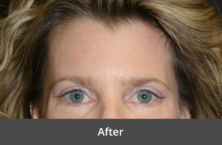 After brow lift surgery at The Advanced Institute for Plastic Surgery, showcasing a woman with lifted brows and a smooth, rejuvenated forehead.