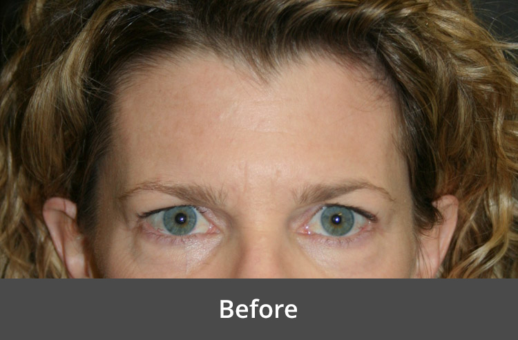 Before brow lift surgery at The Advanced Institute for Plastic Surgery, showing a woman with signs of sagging brows and forehead lines.