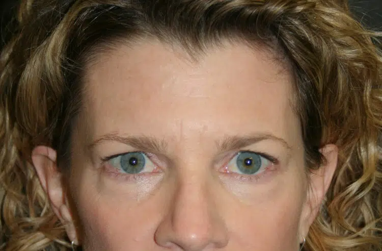 Before brow lift procedure at Advanced Institute for Plastic Surgery in Temecula, Redlands, and Riverside.