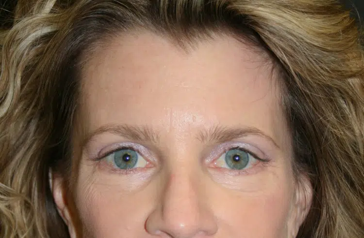 After brow lift procedure at Advanced Institute for Plastic Surgery in Temecula, Redlands, and Riverside.
