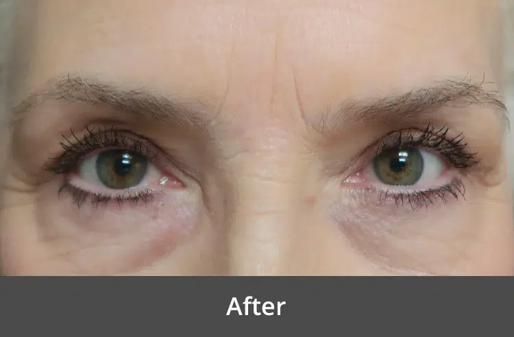After eyelid surgery at The Advanced Institute for Plastic Surgery, showcasing a woman with rejuvenated, youthful eyes.