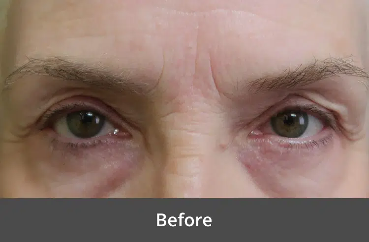 Before eyelid surgery at The Advanced Institute for Plastic Surgery, showcasing a woman with tired eyes, highlighting the transformative potential of the procedure.