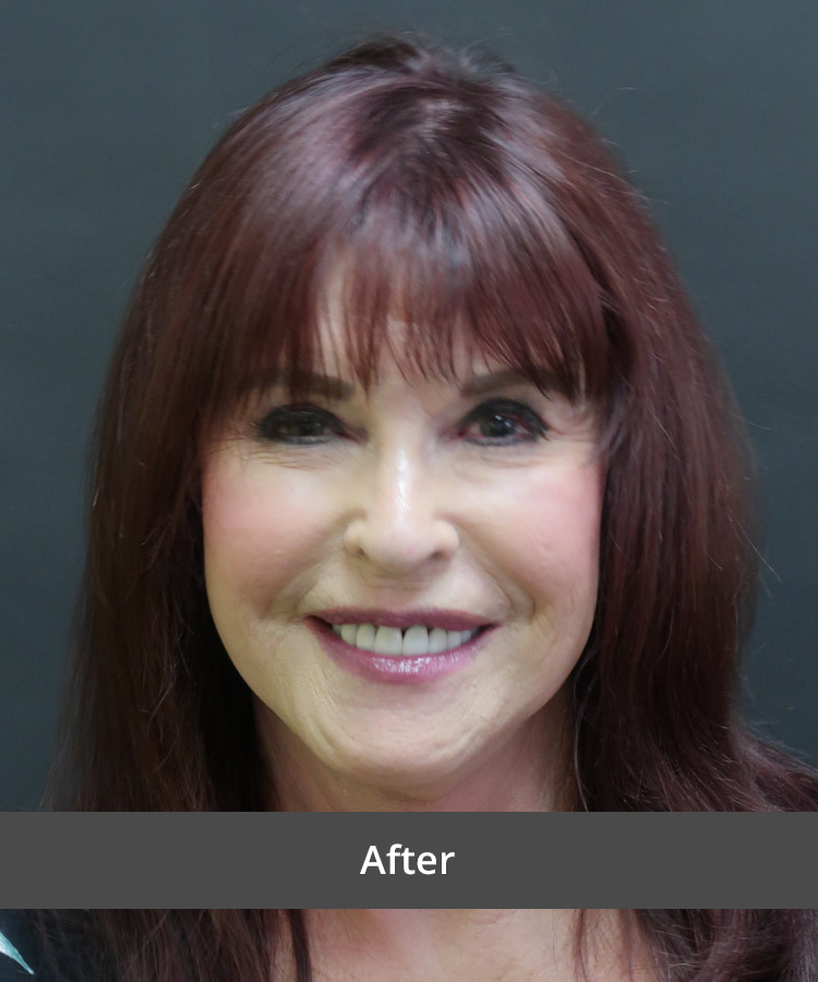 After image of a smiling woman with smooth, lifted skin and a youthful appearance following facelift surgery at The Advanced Institute for Plastic Surgery.