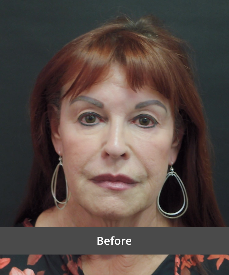 Before image of a woman showing signs of aging, such as sagging skin and wrinkles, prior to facelift surgery at The Advanced Institute for Plastic Surgery.