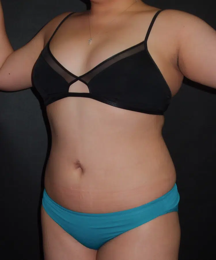 After liposuction image showing results on abdomen and flanks for a 32-year-old patient.