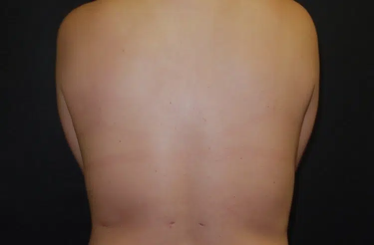 After liposuction back view of female patient at Advanced Institute for Plastic Surgery.