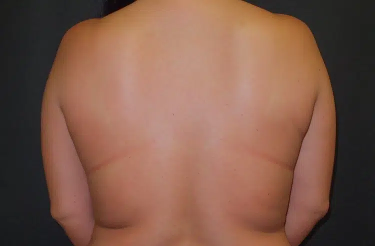 Before liposuction back view of female patient at Advanced Institute for Plastic Surgery.