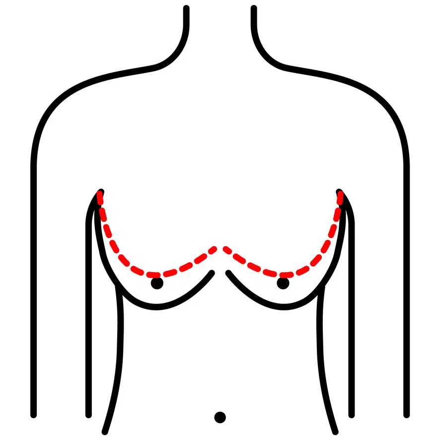 Icon representing breast lift to raise sagging breasts, reversing the effects of pregnancy, nursing, weight loss, and gravity.