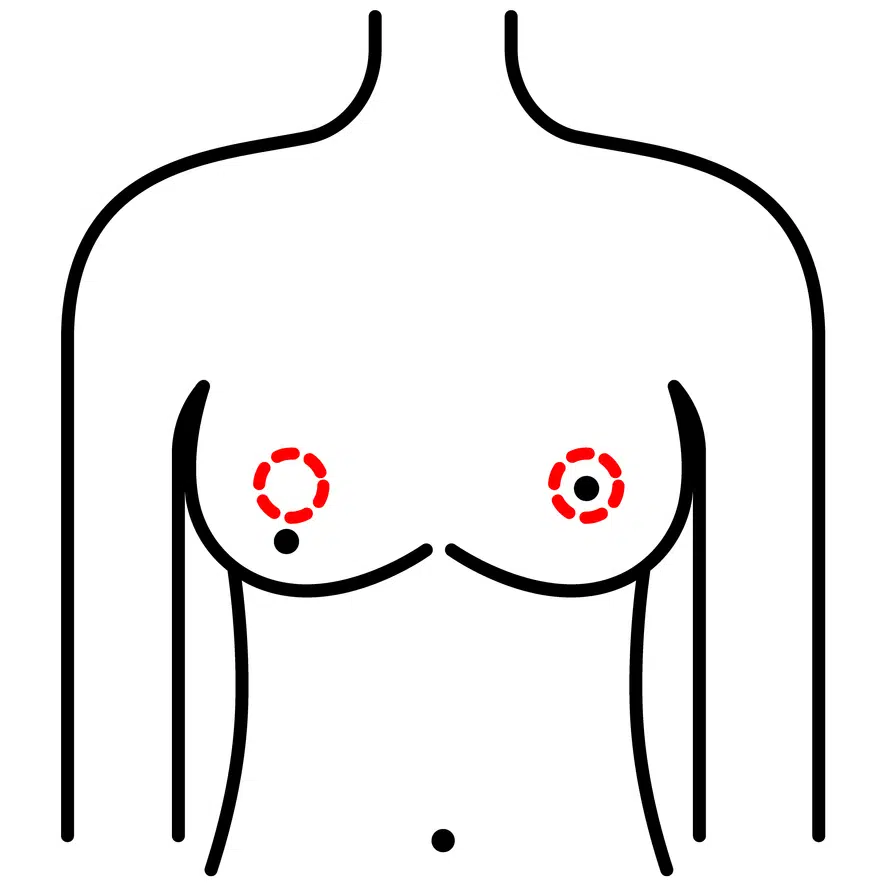 Icon representing breast symmetry restoration through breast lift surgery, including repositioning the areola.